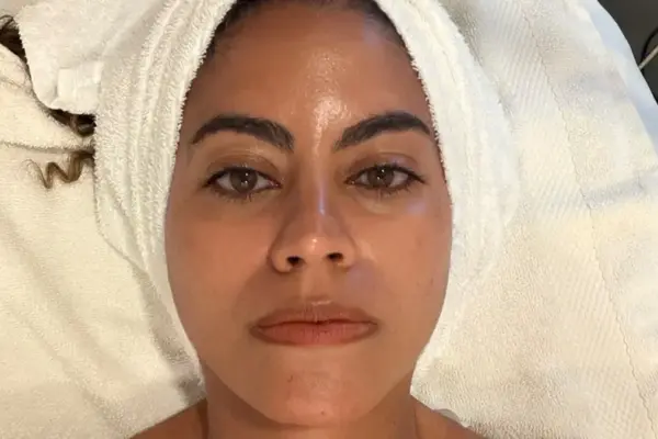 Approaching 40, One Writer Tests XERF: The New Collagen-Stimulating Treatment Making Waves on TikTok